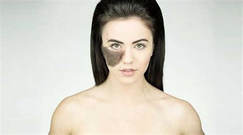 hairy cassandra|This Dancer Refused To Get A Hairy Birth Mark On Her Face.